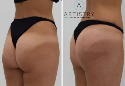 Non-Surgical Butt Lift London & UK