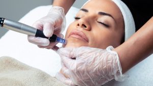 Microneedling Side Effects